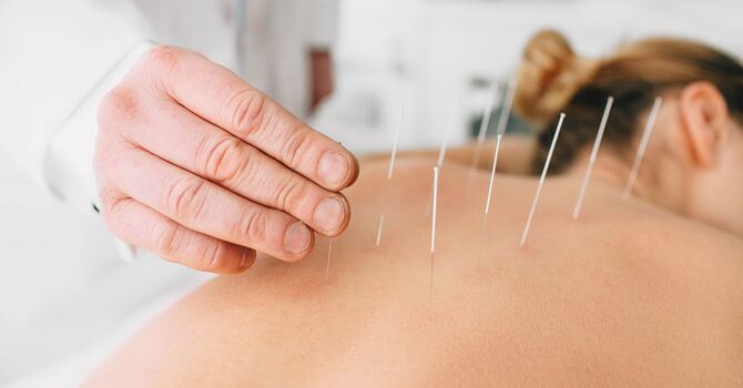 Acupuncture