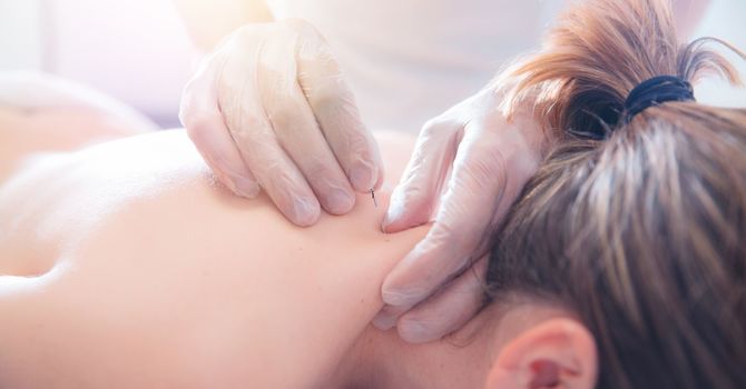 How Acupuncture Can Help With Headaches and Migraines